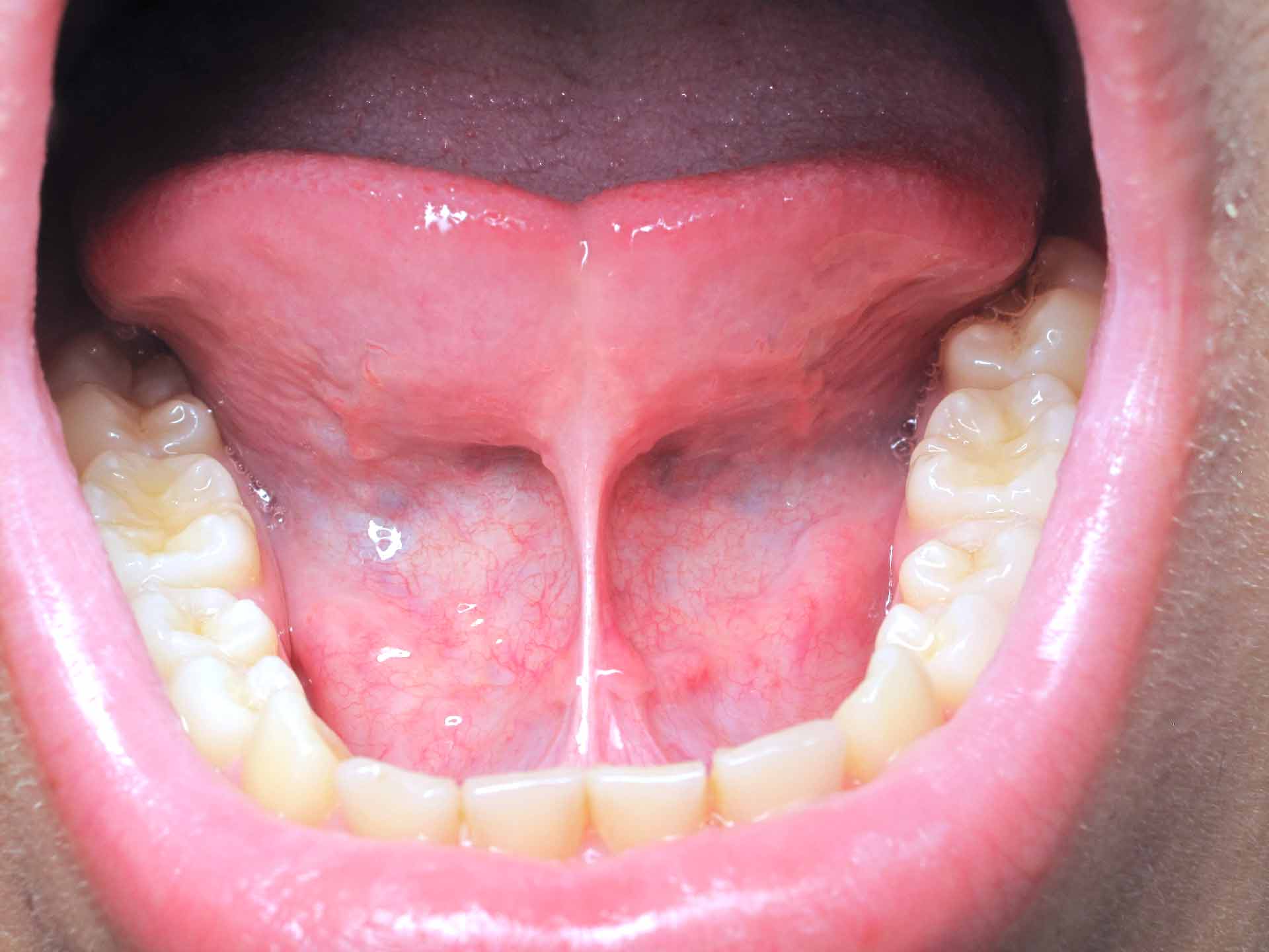 frenulectomia Genova