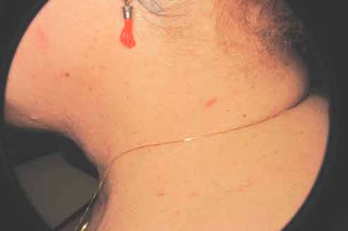 trattamento inestetismi cutanei genova