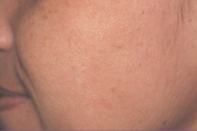 trattamento inestetismi cutanei genova