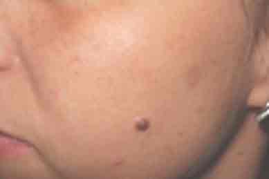 trattamento inestetismi genova