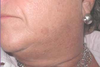 trattamento inestetismi genova