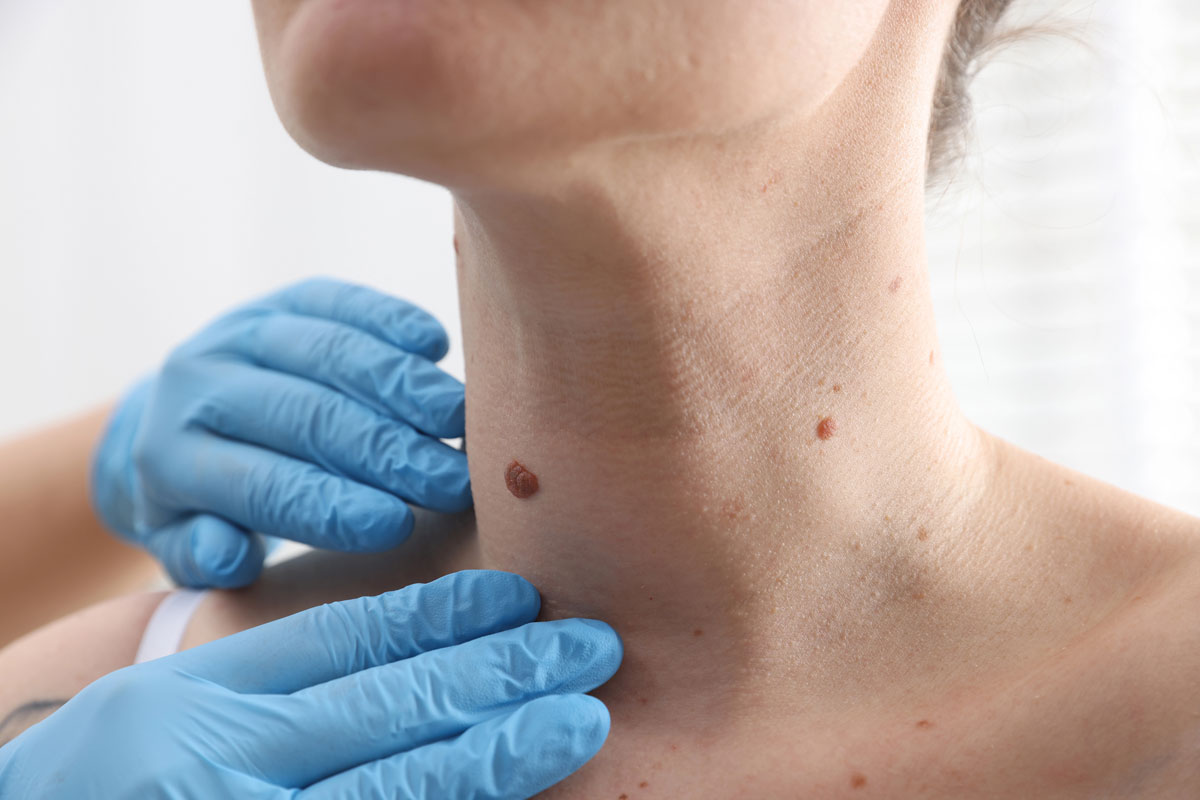 frenulectomia Genova