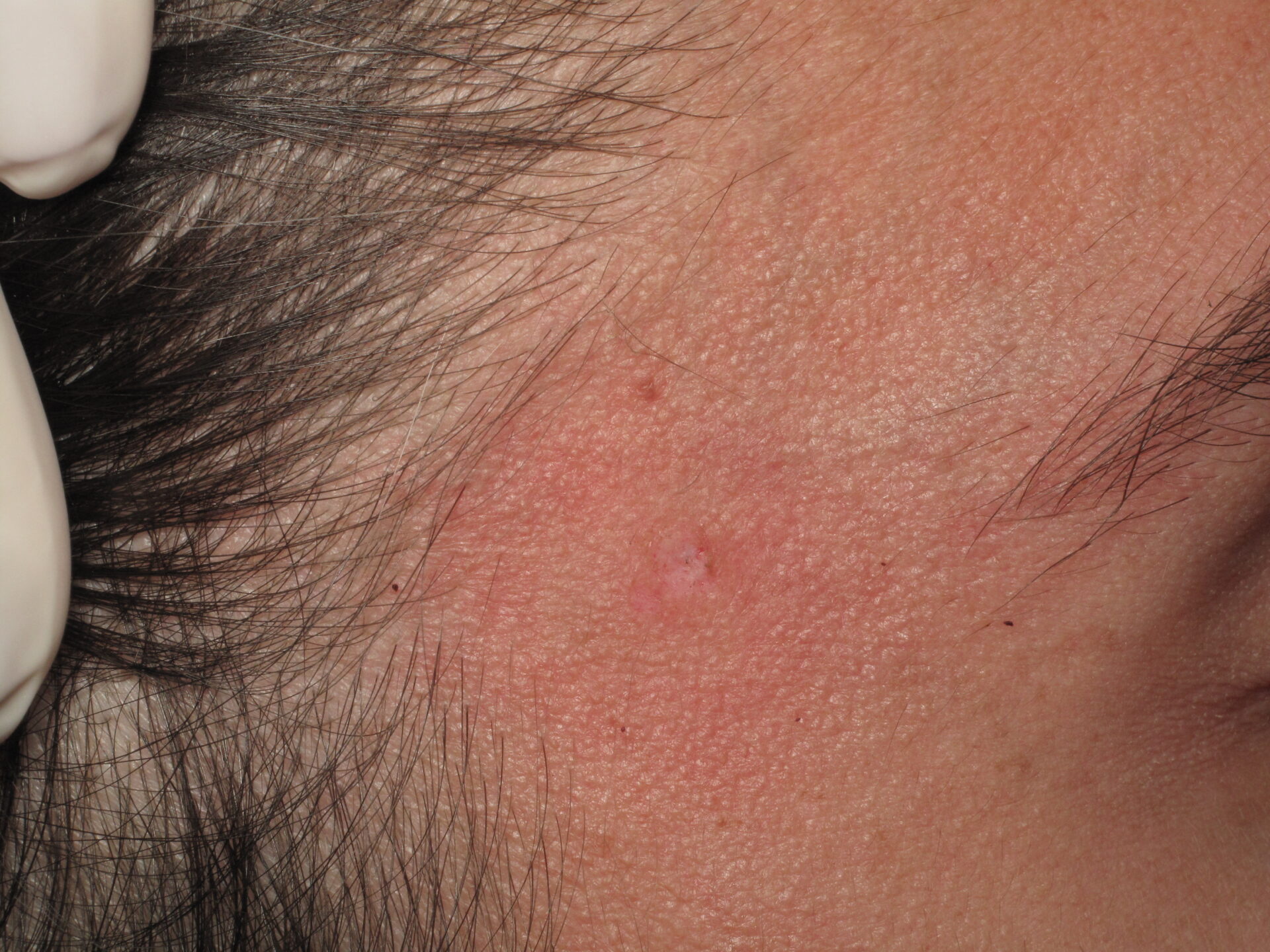 trattamento inestetismi cutanei genova